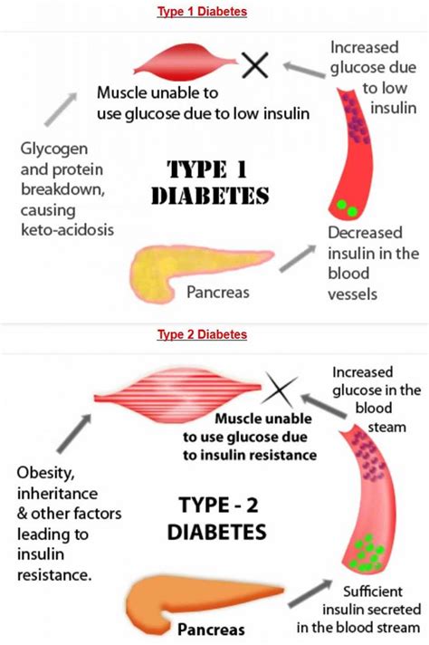 What Is Type 2 Diabetes Symptoms Treatment And Diet For Type 2 Diabetes