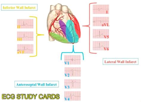 Ecg Lead Correlation W Coronary Arteries Flashcards Quizlet