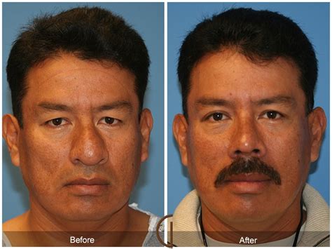 Other male patients prefer to have a slightly sloped profile with a supratip break and the tip raised to about 95 degrees. Before & After Male Rhinoplasty Gallery | Orange County ...