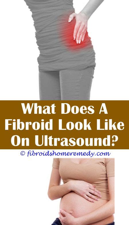 Can Fibroids Burst And Bleed Uterine Fibroids Treatment Fibroid Cyst