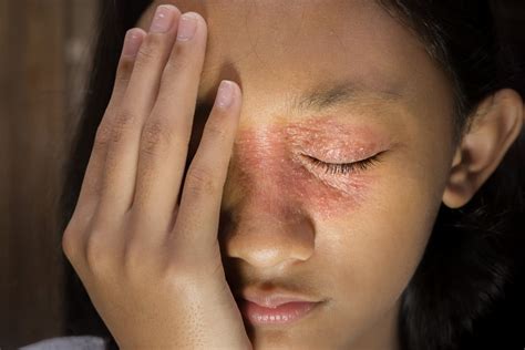 Stress Dermatitis How To Recognize And Treat It Breakinglatest News