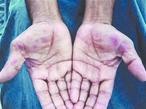 Erythematous Nodules And Plaques Over Both Palms Download Scientific