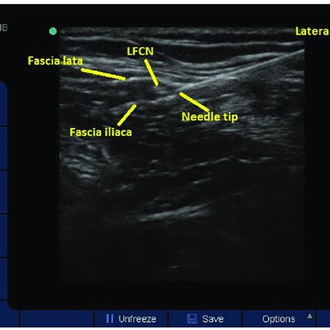 Ultrasound Image Of The Lateral Femoral Cutaneous Nerve Lfcn Lateral