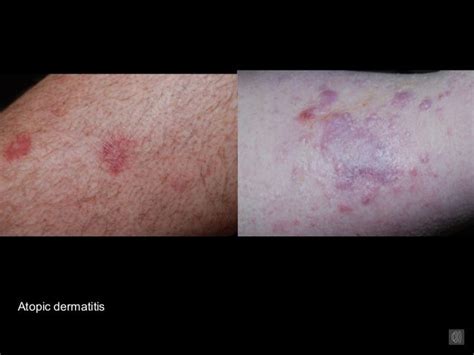 6 Dermatitis And Its Variants