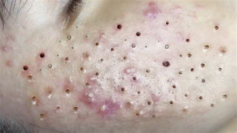 Big Cystic Acne Blackheads Extraction Blackheads And Milia Whiteheads