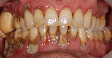Tips To Control Tartar Buildup My Best Dentists Journal Mybestdentists