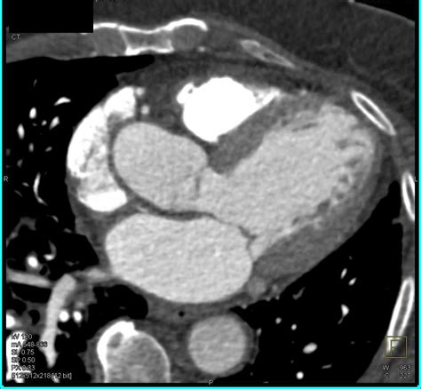 Enlarged Left Ventricle Cardiac Case Studies Ctisus Ct Scanning