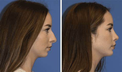 Chin Implant And Augmentation Layton Ut Bitner Facial Surgery