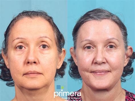Neck Lift Before And After Pictures Case 852 Orlando Florida