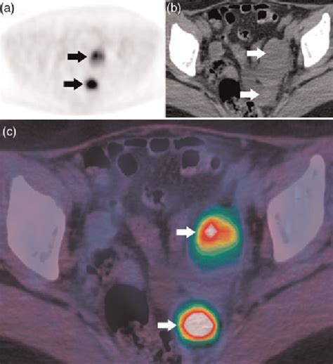 Figure 2 From Fluorine 18 Fluorodeoxyglucose Petct For The Evaluation
