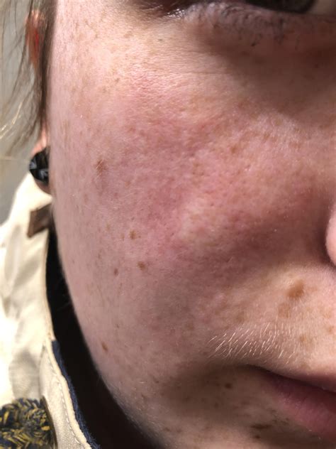 A cyst or a pimple on my face... either way it’s coming out after work