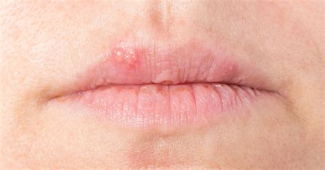 Home Remedies Coping With Cold Sores