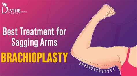Best Treatment For Sagging Arms Reshape Your Hanging Arm With