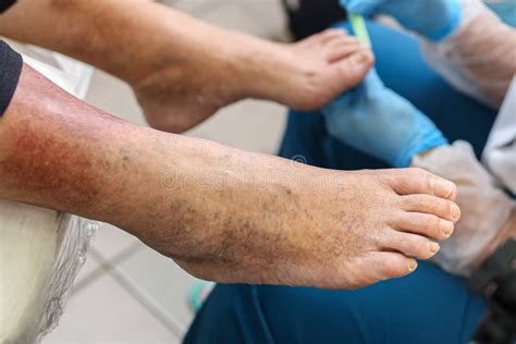 Leg Vein Disease Dark Spots On The Skin Of The Legs Treatment