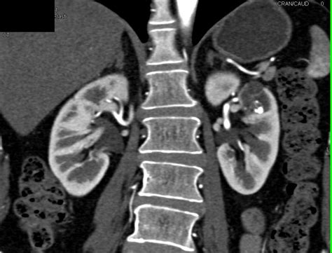 Bosniak 2f Cyst Left Kidney Kidney Case Studies Ctisus Ct Scanning