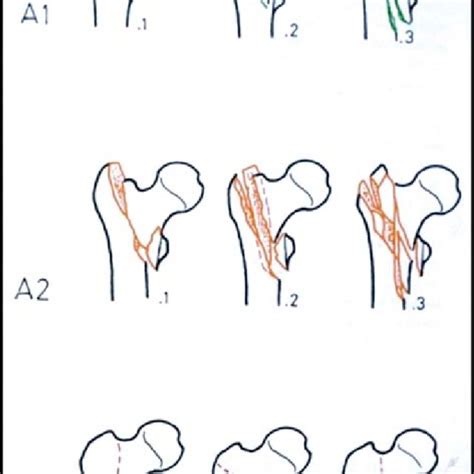Pdf Trochanteric Fractures Operative Technique