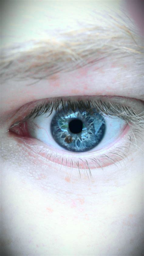 My Eye Freckle Eyes