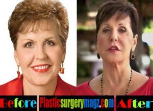 Joyce Meyer Plastic Surgery Gone Wrong Is That True Plastic Surgery Magazine