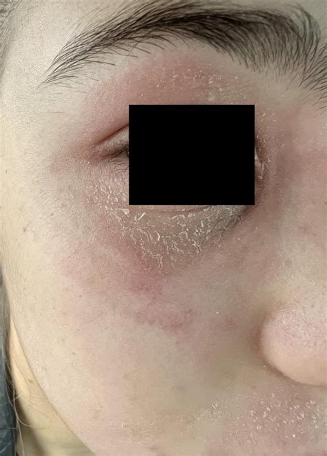Eyelid And Facial Eczema Reczema