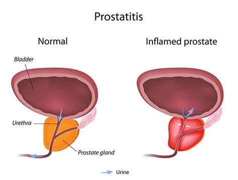 Signs Symptoms And Causes Of Prostatitis In Men