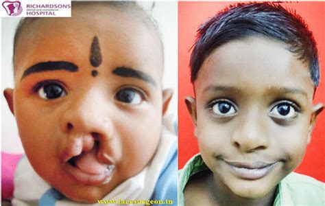 Child Cleft Palate Surgery Hospital In India Richardsons Hospital