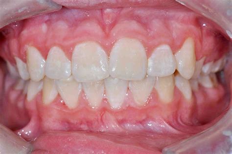 Why Some People Have White Spots On Their Teeth Directorio Odontológico