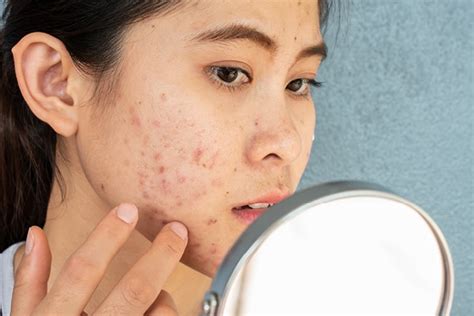 The Best Ways To Get Rid Of Pitted Acne Scars Be Beautiful India