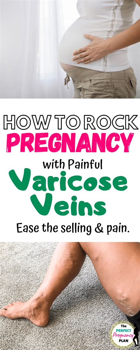 Ptregnancy Varicose Veins And All The Best Ways O Manage Them