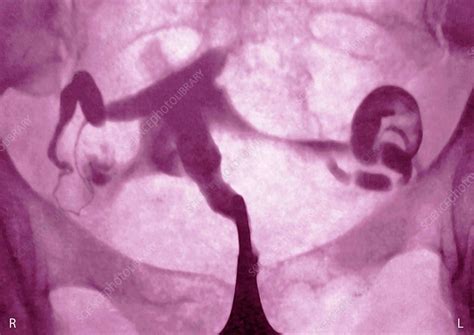 Extra Uterine Pregnancy X Ray Stock Image C0270960 Science