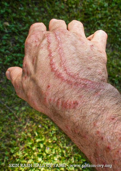 Poison Ivy Hand Rash With Lines Poison