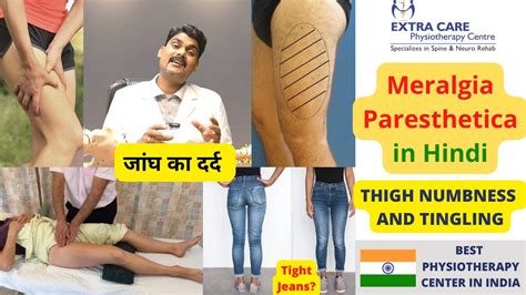 Meralgia Paresthetica In Hindi जांघ का दर्द Thigh Numbness Burning