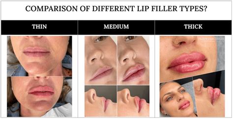How Long Do Lip Fillers Last Best Scottsdale Lip Filler Info Top