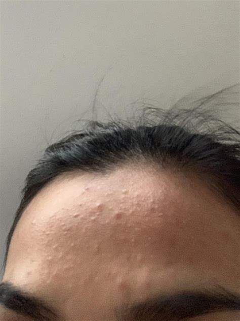 Using Curology For Months And Bumps On Forehead Suddenly Appeared My