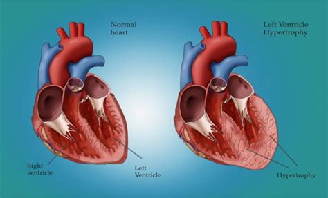 Left Ventricular Hypertrophy Lvh Also Known As An Enlarged Heart Is Associated With A Nearly