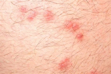 Identifying Bug Bites Heres What Bit You The Healthy