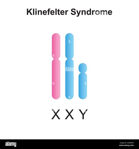 Klinefelter Syndrome Karyotype Hi Res Stock Photography And Images Alamy