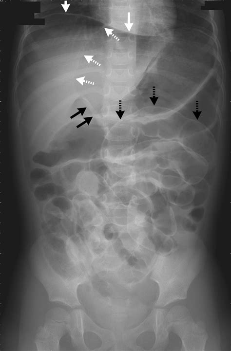 Radiologic Signs Of Pneumoperitoneum — Nejm