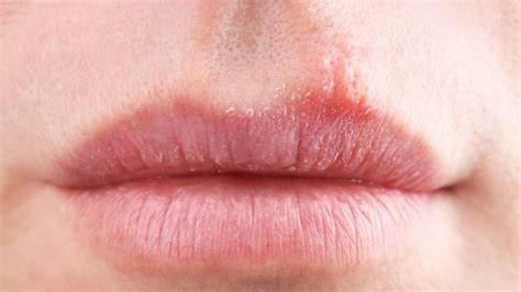 Bumps On Lips 9 Causes Home Remedies And Prevention T