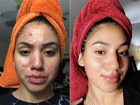 Pictures of gel up with kinky for round face ~ bangs for round face: Teen shares how she cleared her severe acne using cheap ...