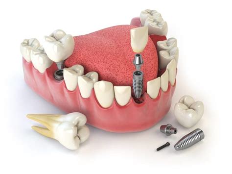 Considering Dental Implants Everything You Need To Know Dental