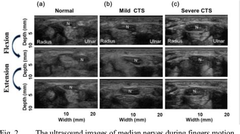 Figure 1 From Assessment Of Median Nerve Mobility By Ultrasound Dynamic