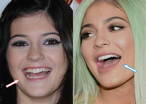 Kylie Jenner Before and after: Nose Job, Lip Injections ...