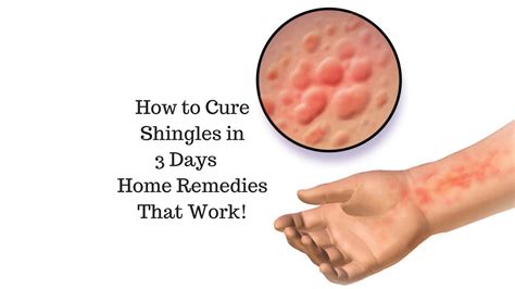 How To Cure Shingles In 3 Days Home Remedies That Work Youtube