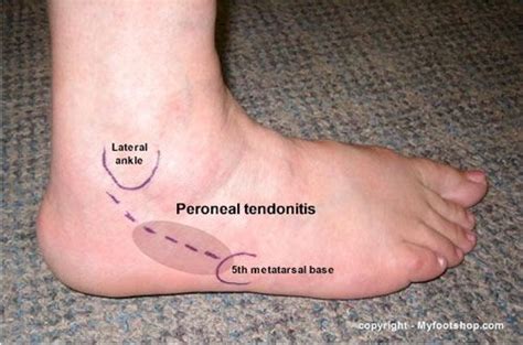 Peroneal Tendonitis Causes And Treatment Options Printer Friendly