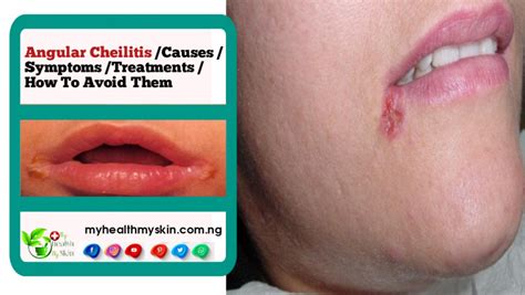 Angular Cheilitis Perlèche Causes Symptoms Treatments And How To