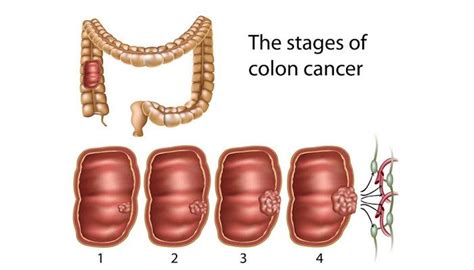 Treatments Of Colon Cancer Archives Oncoplus Hospital