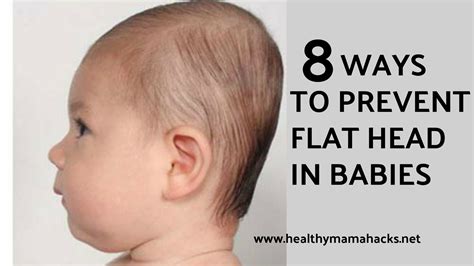 Flat Head Syndrome What Is It And How To Prevent 41 Off