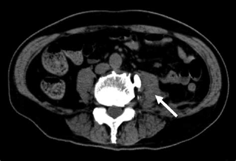 Ct Image Shows No Iliopsoas Abscess In The Left Iliopsoas Muscle Arrow