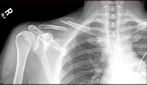 X Ray Of My Broken Collarbone Bicycling