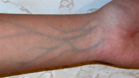 Blue Veins On Palms Of Hands After Shower New Abettes